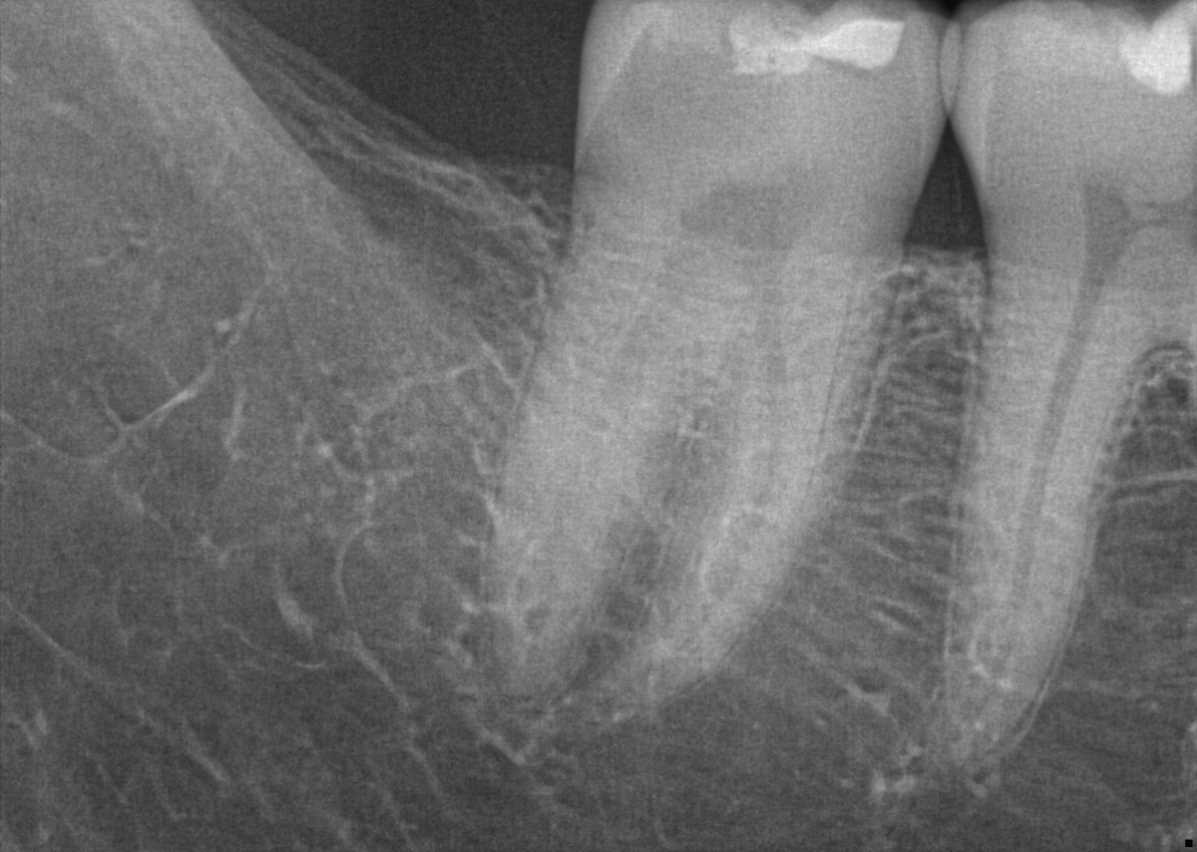 X-ray Before Apexification Therapy